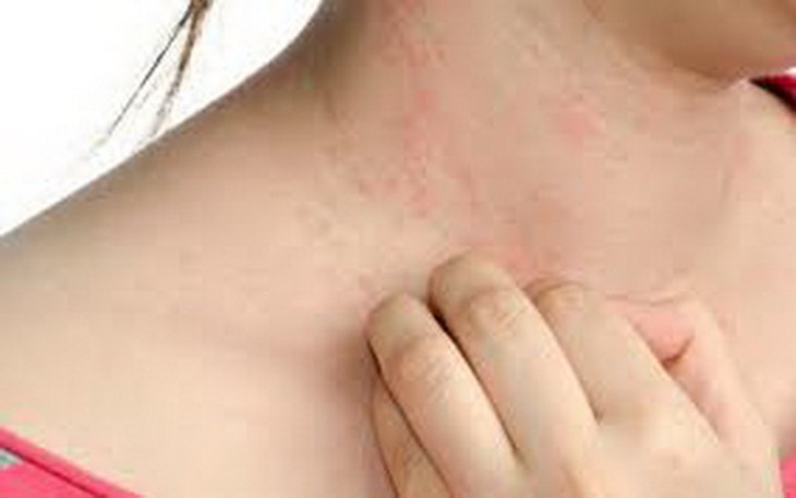 Phát ban da một triệu chứng thường gặp khi mắc COVID-19.